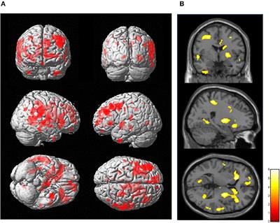 In vivo Illustration of Altered Dopaminergic and GABAergic Systems in Early Parkinson's Disease